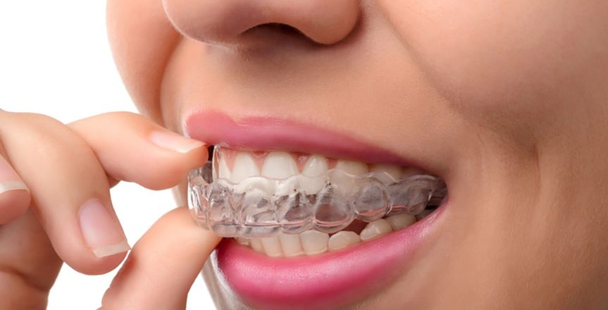 Invisalign Braces - See if They are the Right for You!